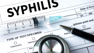 Syphilis in the United States