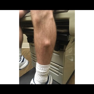 Lower Leg Mass with Uncharacterizable Malignancy