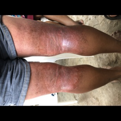 Floating Doctors Case: Popliteal Rash
