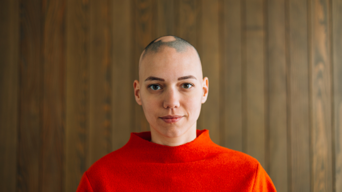 woman with alopecia